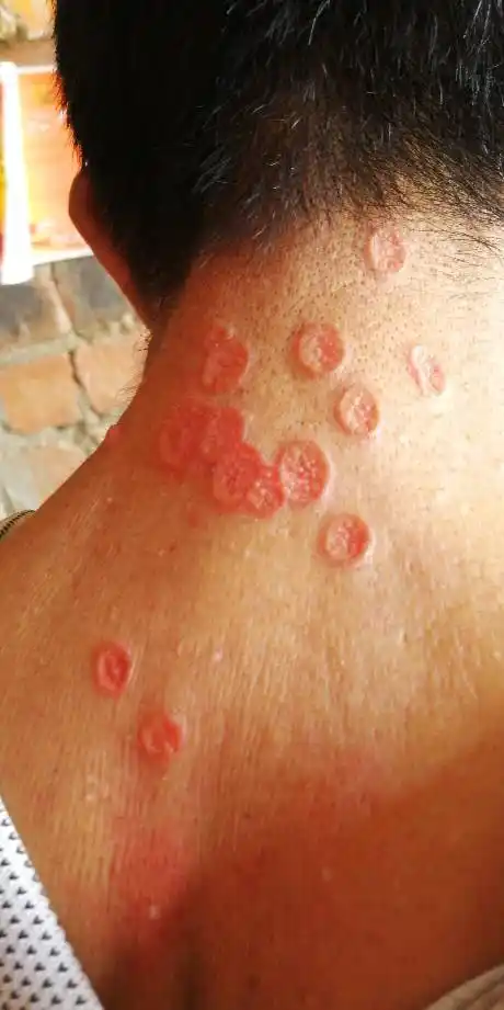 大家看看这张图,有没有朋友知道这是什么皮肤病_百度知道