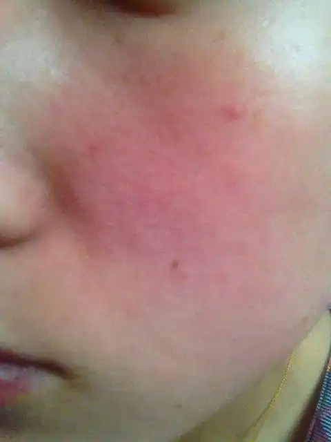 春季皮肤过敏修复小妙招