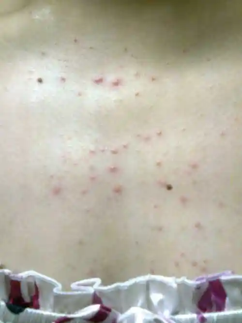 皮肤性病科 皮肤病 过敏 您的回答:结合你的症状以及用药后反复,我们