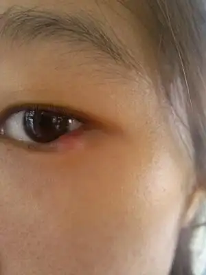 你好,我现在怀孕31周,左眼下眼睑长了颗大的痘痘,很明显,好像裏面有脓