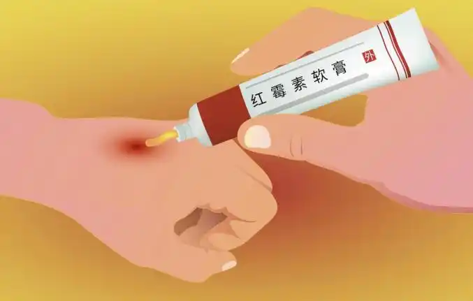 你以为红霉素软膏抹哪里都行医生紧急提醒
