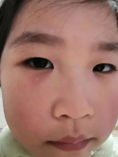 有姐妹知道孩子眼睛下面起的这疙瘩怎么回事