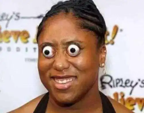 世界上眼球最突出的女人金古德曼突出眼眶11毫米