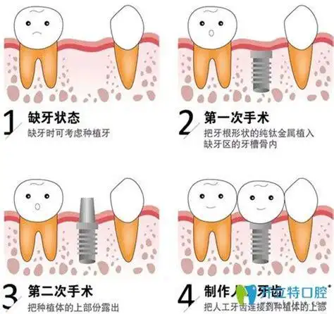 种植牙制作过程分为几个步骤种植牙详细步骤图解2022已更新今日更新