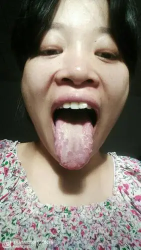 舌头上好多溃疡三个月了就是不好