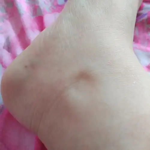 iga肾病,这两天两脚有点肿咯,怎么办?