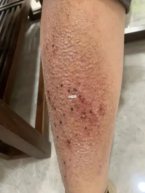 皮肤淀粉样变源于长期累积代谢