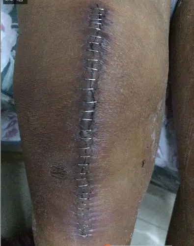 术后拆钉器医用一次性皮肤吻合器 专用起钉器医院手术用无菌包装