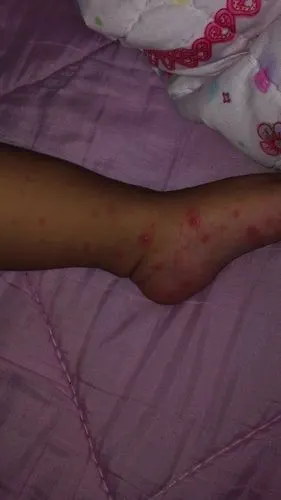 医生你好,我家宝宝传染了手足口病,一般要几天才能痊愈呢?急死