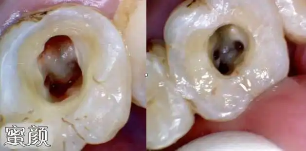 美然开髓决定根管治疗成败的关键之一