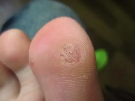 鸡眼图片初期症状 鸡眼早期症状图片