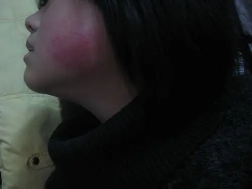 我用化妆品结果过敏了,现在脸部皮肤红肿了,特别痒,怎么止痒并治疗?