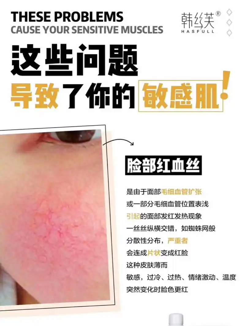 肌肤问题——红血丝 面部毛细血管扩张 或部分毛细血管位置浅