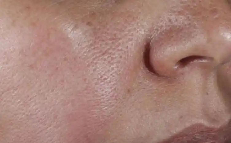 毛孔粗大怎么办改善毛孔粗大的方法