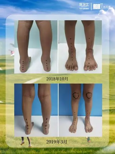 孩子走路内八字等长大就好了吗