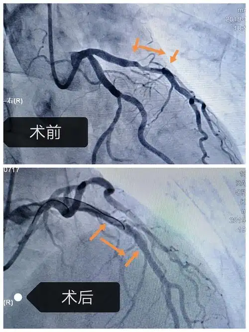 让爱启航～朔州现代医院心导管室于12月16日成功完成11例冠脉造影检查