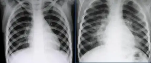 【育儿学堂】小儿支气管肺炎(下篇) ----治疗与护理