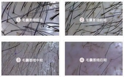 头发的毛囊一般多久会闭合长不出头发