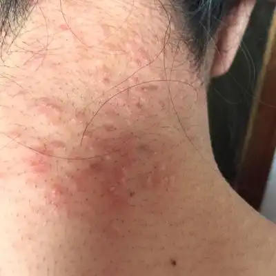 孕38 3,脖子上长了一片红疹,很痒,请问可以用药吗?