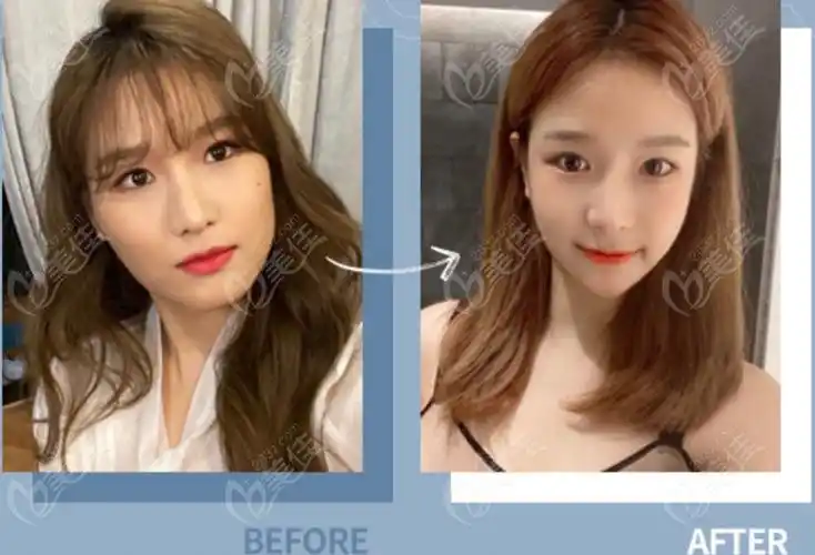 韩国百分之一1%医院面部轮廓磨骨前后对比照片