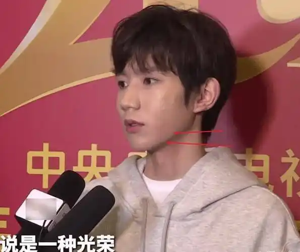 王源再次接受电视采访,在"照妖镜"之下,面部上痘痘很明显!