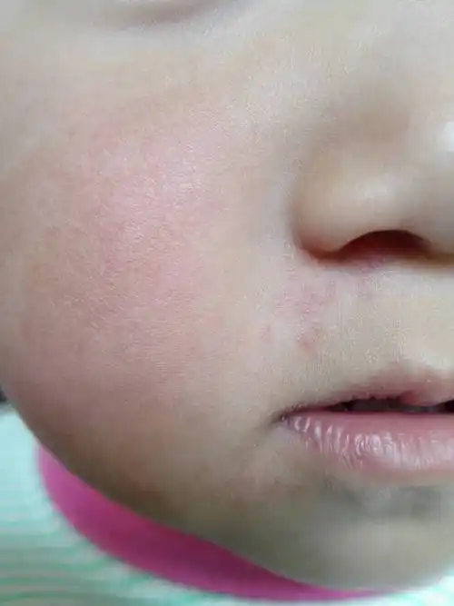 为您推荐: 其他回答 你好,这多是小儿湿疹,是由于孩子对蛋白质过敏