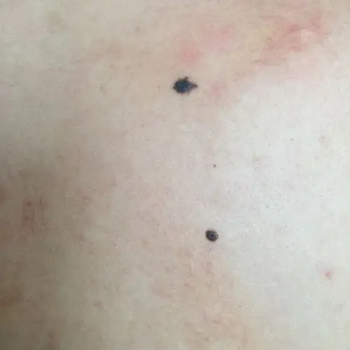 后背的一个黑痣,有危险么?