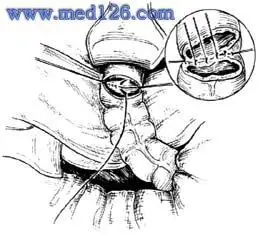 乙状结肠直肠切除端端吻合术(dixon)