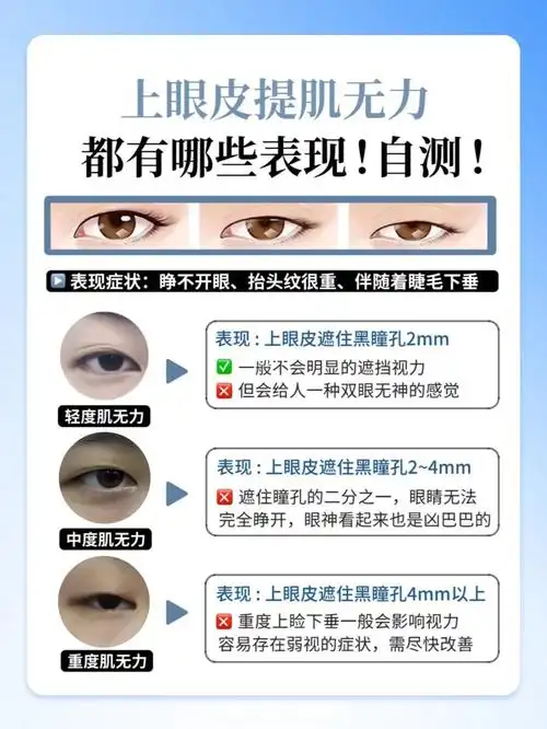 上眼皮肌无力表现和自测,具体解决方案get