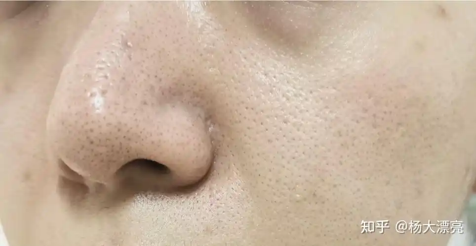 怎样有效去黑头收缩毛孔? - 知乎