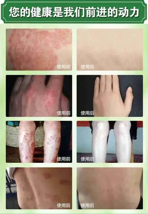 百草膏,皮疹,皮炎,各种癣的好帮手,拥有百草膏在手,打片天下无敌手….