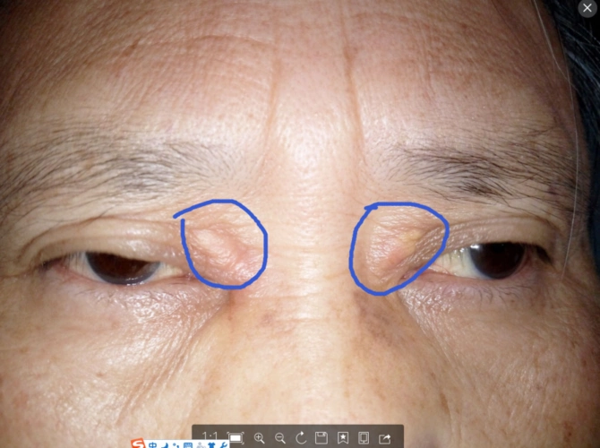 眼角靠近鼻子出长了两肉疙瘩