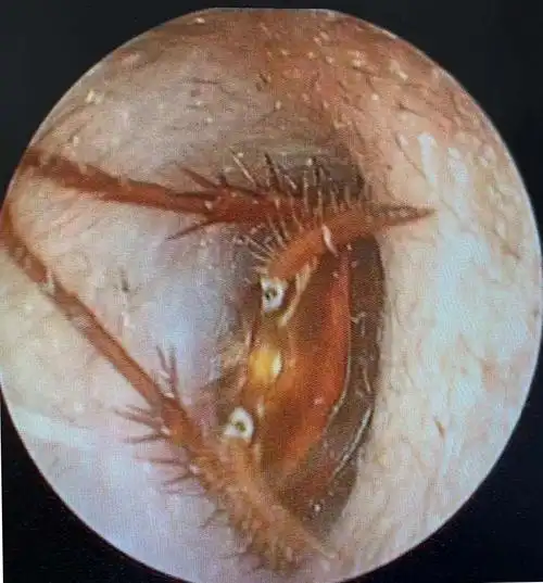 萧山大伯耳朵里钻进一只蟑螂,取出时还是活的!医生提醒