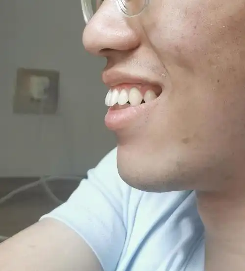 很明显上排牙完全把下排牙包住了,这就是传说中的"深覆合"吗?