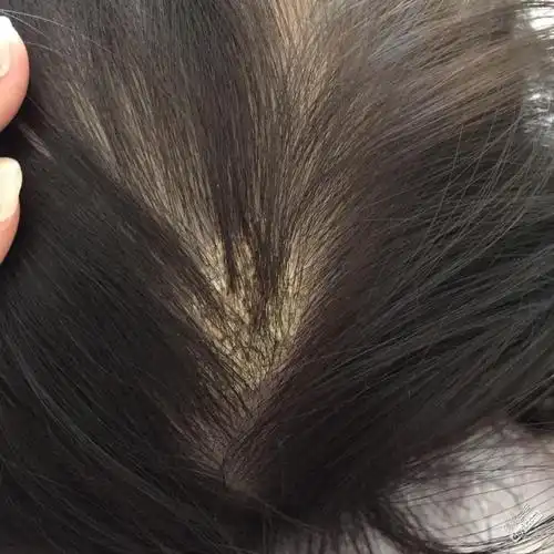 七个月宝宝头皮结痂,怎么回事?