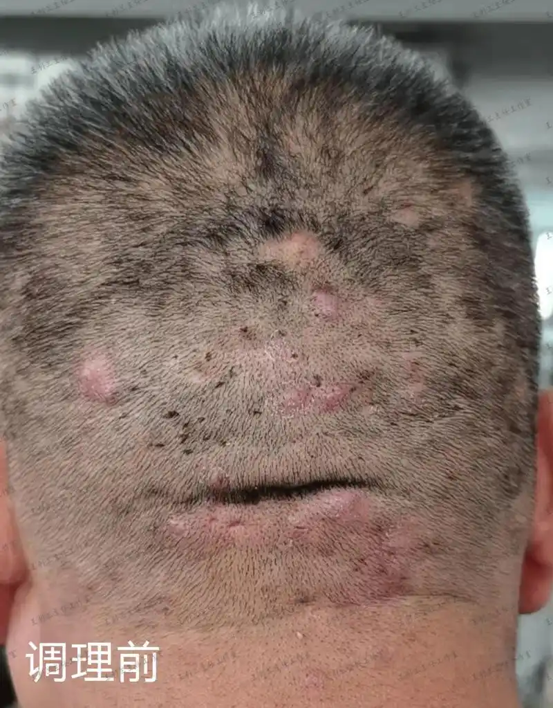 门诊这位中年男子,头上反复长毛囊炎疙瘩,情况比较严重.