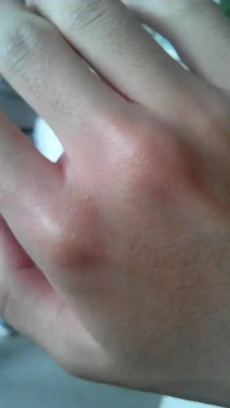 我在理发店工作,手不小心被烫伤了,现在给人洗头一碰到热点的水就疼