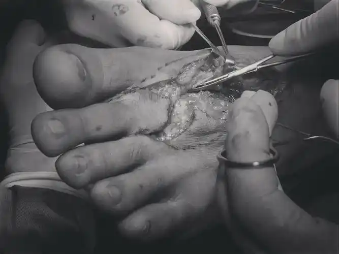 嘉宁医院骨三科足二趾移植拇指再造术