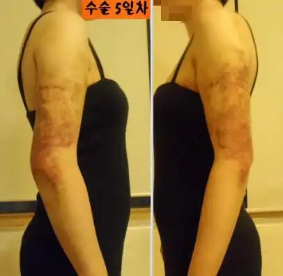 【高清多图】一女子手臂吸脂手术2周后记!