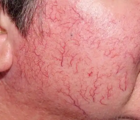 皮肤有红血丝怎么办(皮肤上有紫色血丝图片)-cosg百科