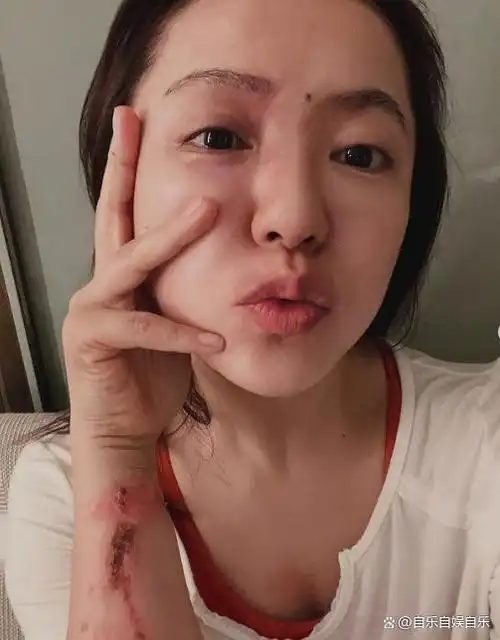 然而,最近她却发生了烫伤意外,导致左手和左脸上起了水泡并红肿.