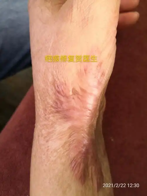 手部烧烫伤疤痕