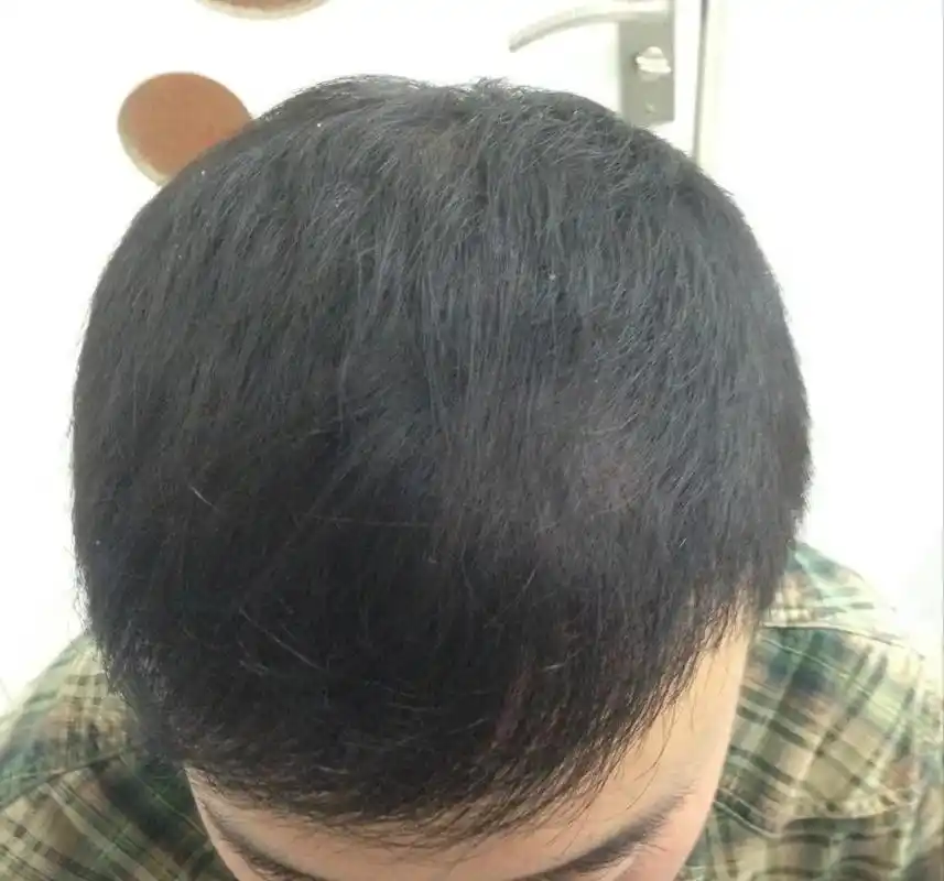 我们可以看到,头发已经基本恢复浓密,稀疏的地方几乎看不到了,真的是