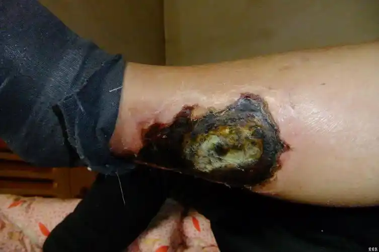 17:35:56        患者男79岁,男,左侧下肢皮肤坏死半年,3个月前在省