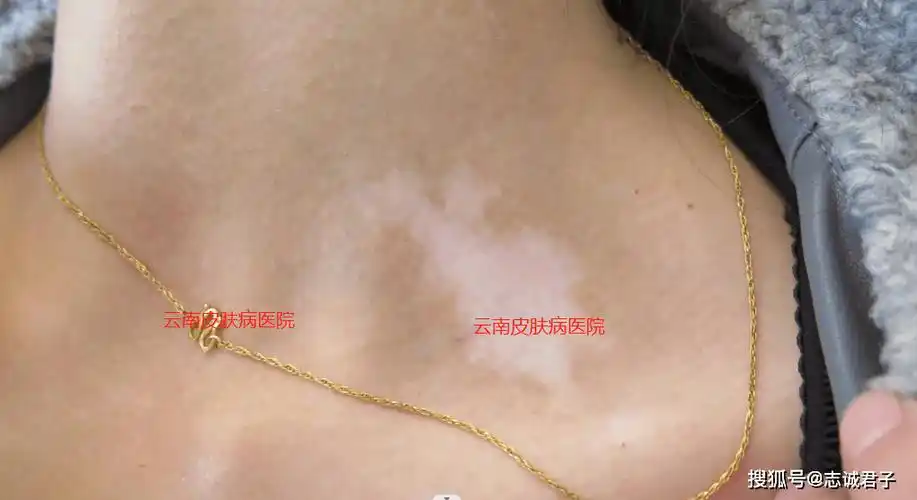 白斑和白癜风的区别,一文读懂_皮肤_部位_治疗