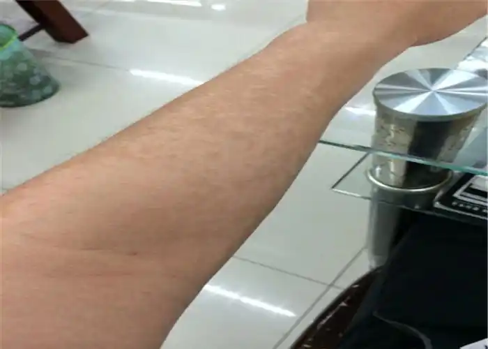 花斑癣头部脱毛症状图片