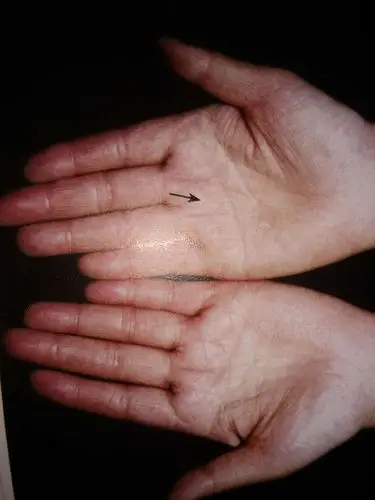 风水玄学  手相掌纹 9线对诊断肿瘤有什么特殊意义科研征实癌症与环境