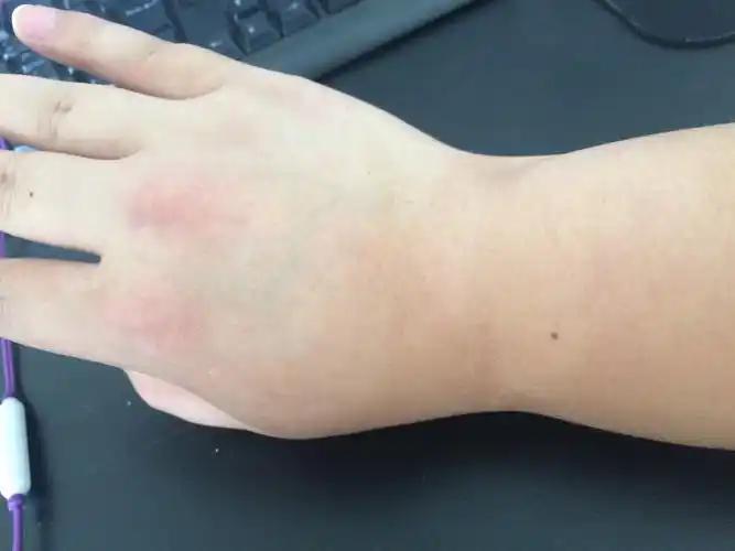 右手手背的皮肤颜色不一样好像癣一样一大块比其他部位的颜色白冬