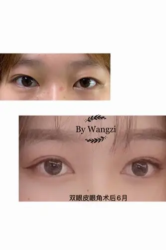 分享一些术前,术后对比照_双眼皮手术_双眼皮手术治疗介绍 - 好大夫