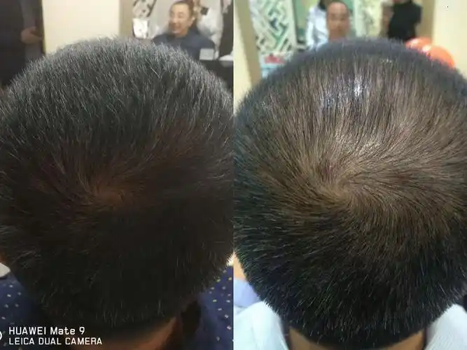 生发成功案例 - 美篇